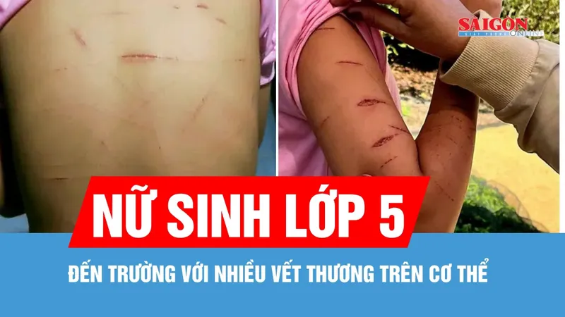 Cà Mau: Phát hiện học sinh lớp 5 đến trường với nhiều vết thương trên cơ thể
