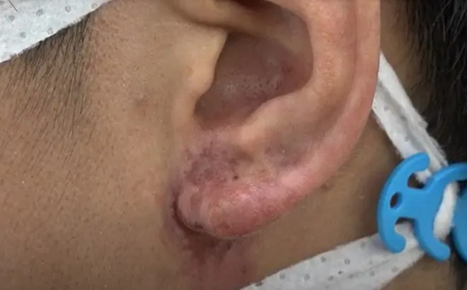 Tắc mạch, hoại tử do tiêm filler