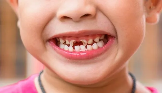 Hơn 85% trẻ 6-8 tuổi gặp các bệnh về răng miệng