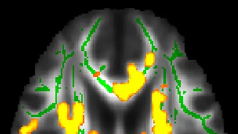 Mỡ nội tạng cao làm tăng nguy cơ mắc Alzheimer