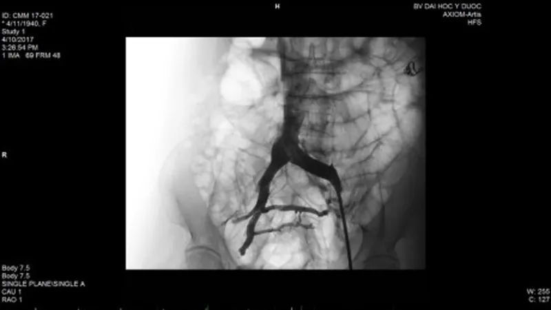 Hình ảnh stent đặt trong lòng tĩnh mạch