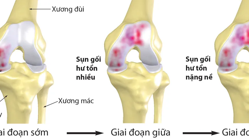 Bệnh nhân thoái hóa xương, khớp ngày càng trẻ hóa