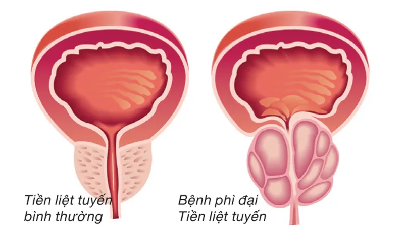 Bí kíp Dứt điểm phì đại tiền liệt tuyến không cần phẫu thuật