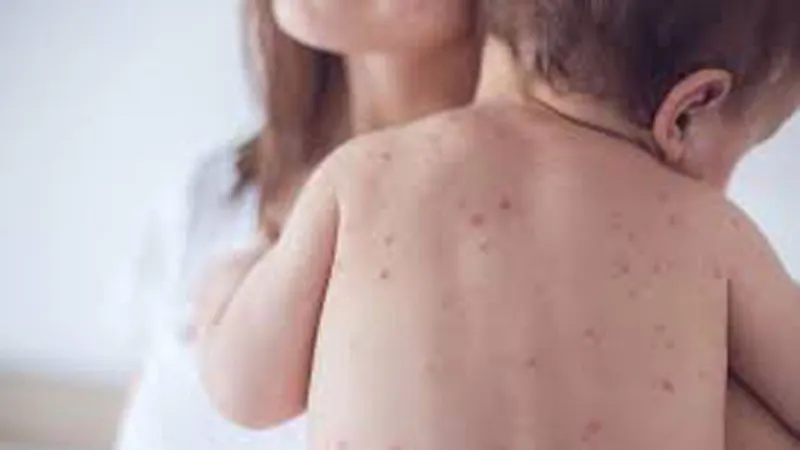 Số người mắc sởi ở Hà Nội tăng gấp 4 lần năm 2017