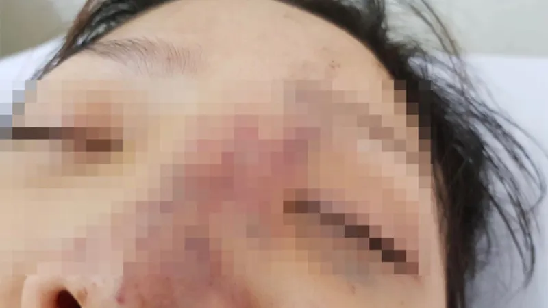 Tiêm filler giá rẻ, nữ sinh viên có nguy cơ mù mắt 