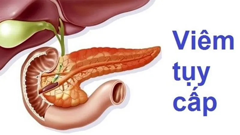 Đề phòng bệnh viêm tụy cấp sau tết