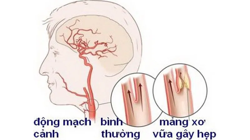 Chớ coi thường bệnh hẹp động mạch cảnh