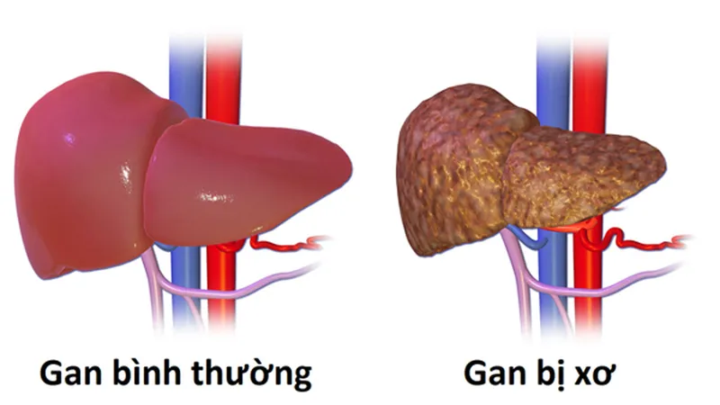 Ai là người dễ mắc bệnh ung thư gan?