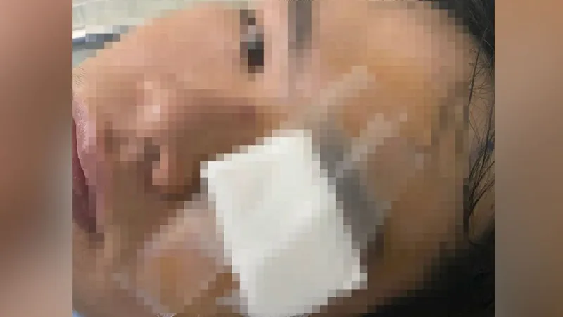 Anh N. với thương tích trên mắt