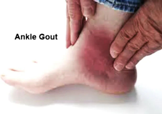 Cách mới chữa trị sỏi thận và bệnh gout