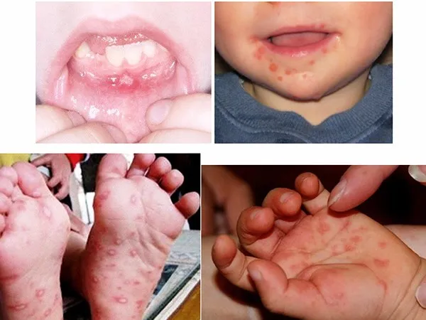 Cẩn trọng với dung dịch trị bệnh tay chân miệng