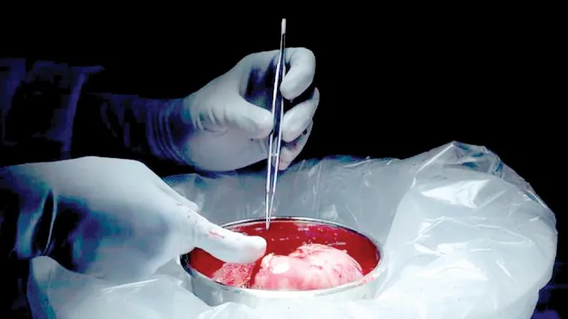 Ghép thận từ người hiến tạng nhiễm HIV còn sống