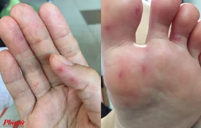 Ghi nhận ca mắc tay chân miệng ở người lớn