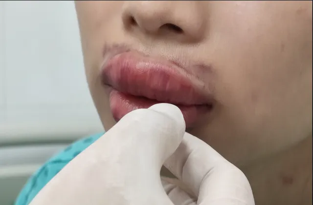 Môi sưng phồng căng cứng sau tiêm chất làm đầy