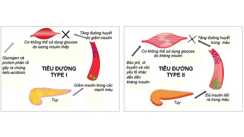 Căn nguyên của bệnh tiểu đường: Mấu chốt nằm ở tuyến tụy