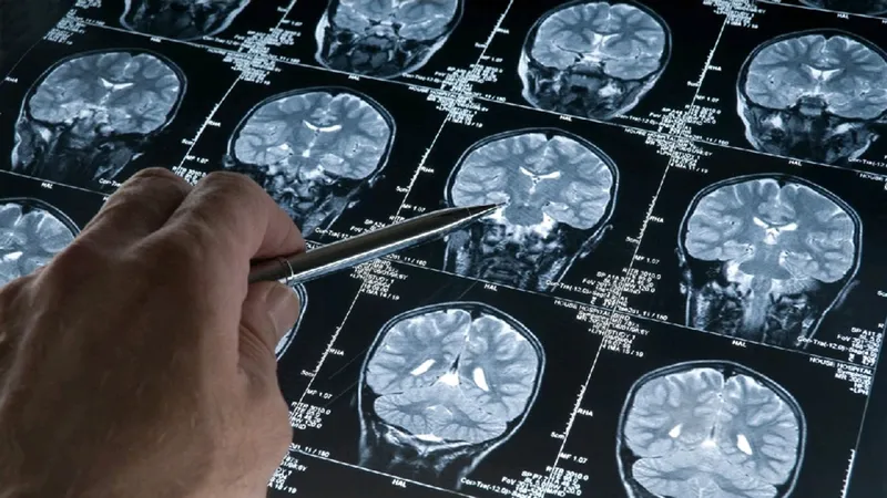 Điều trị bệnh Parkinson bằng sóng siêu âm có nhiều triển vọng