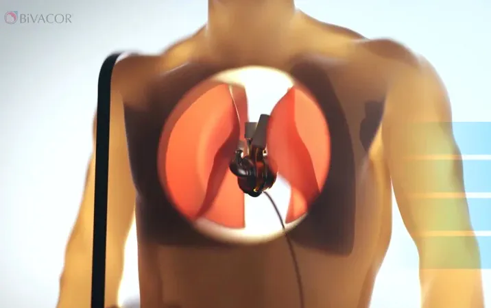 Tim nhân tạo mở ra cơ hội mới cho những bệnh nhân chờ cấy ghép tim