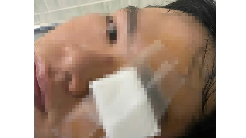 Anh N. với thương tích trên mắt.