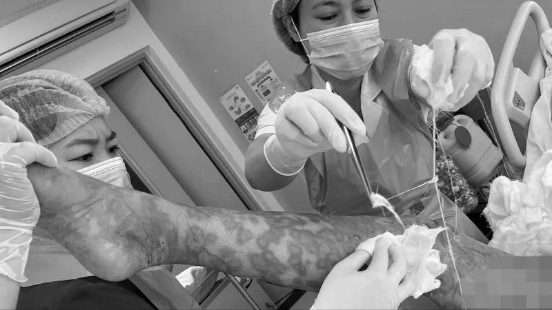 Cứu sống một phụ nữ nhiễm độc toàn thân do dị ứng thuốc