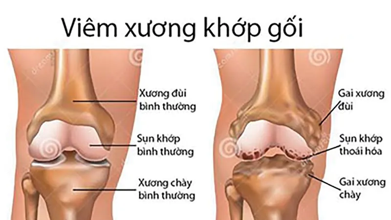 Từ biệt đau đớn do bệnh xương khớp