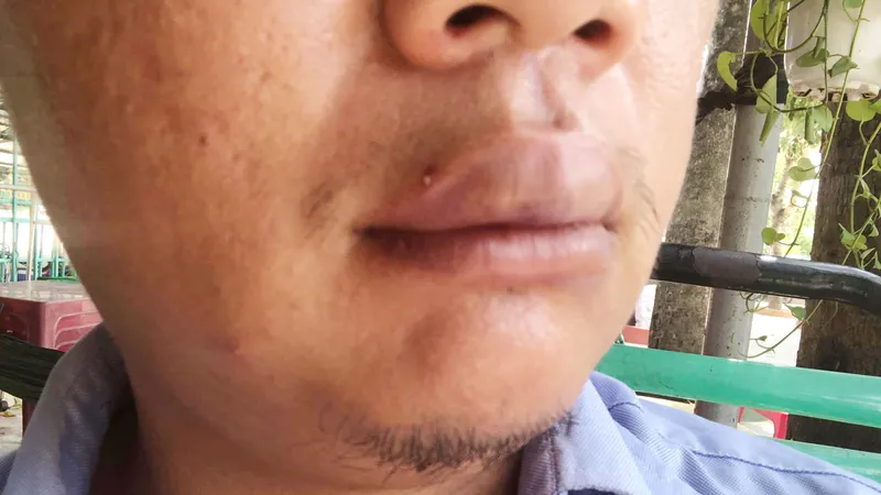  Phóng viên VOV bị hành hung, thương ở vùng mặt, kể lại sự việc.