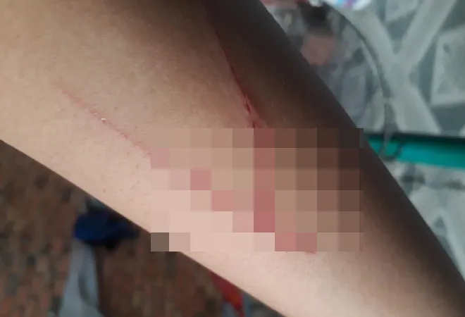Bé gái thừa nhận vết thương trên tay là do tự dùng vật nhọn rạch vào tay mình, không phải bị người khác gây thương tích như trình báo ban đầu