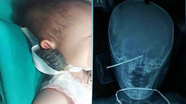 Bé 11 tháng bị que thép xe đồ chơi xuyên vào đầu
