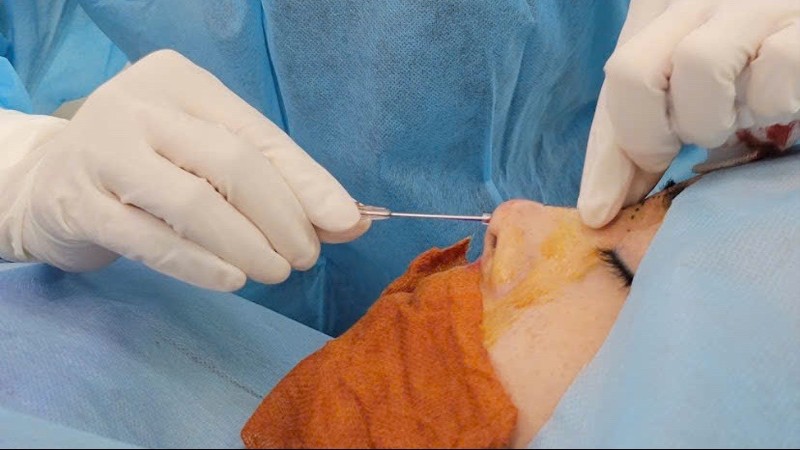 Nearly 35,000 cosmetic procedure complications reported annually in Vietnam