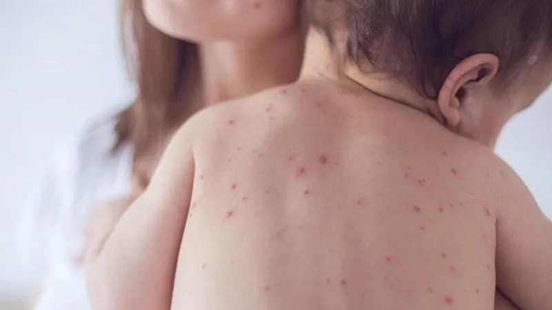 Đắk Lắk ghi nhận 2 ổ dịch thủy đậu