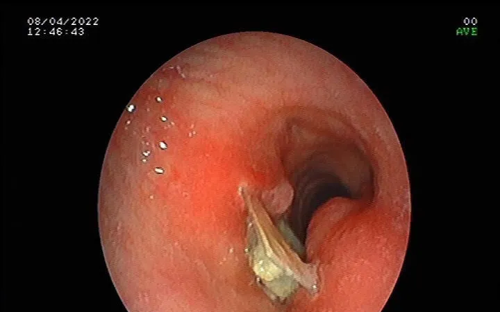 Ho kéo dài do dị vật đường thở
