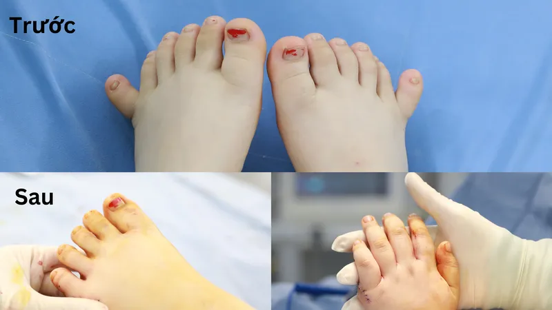 Một số hình ảnh tay chân cháu L. trước và sau khi phẫu thuật