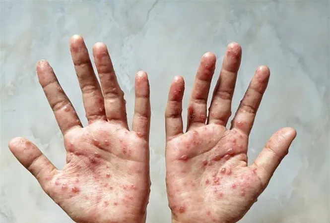 Các ban đỏ nổi trên tay một bệnh nhân mắc đậu mùa khỉ. Ảnh: Shutterstock/TTXVN