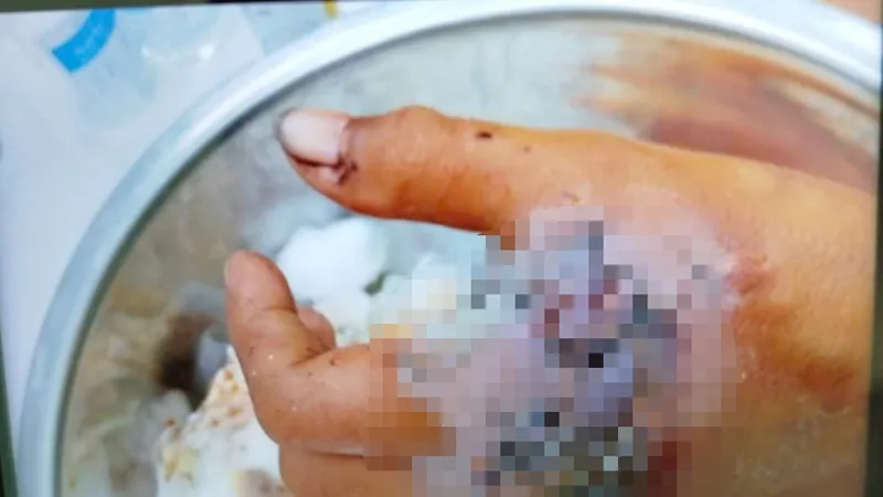 Bệnh nhân Đ.S.R. bị dập nát bàn tay do nghịch pháo