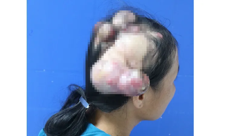 Phẫu thuật thành công cho bệnh nhân bị “mọc sừng” do ung thư da đầu