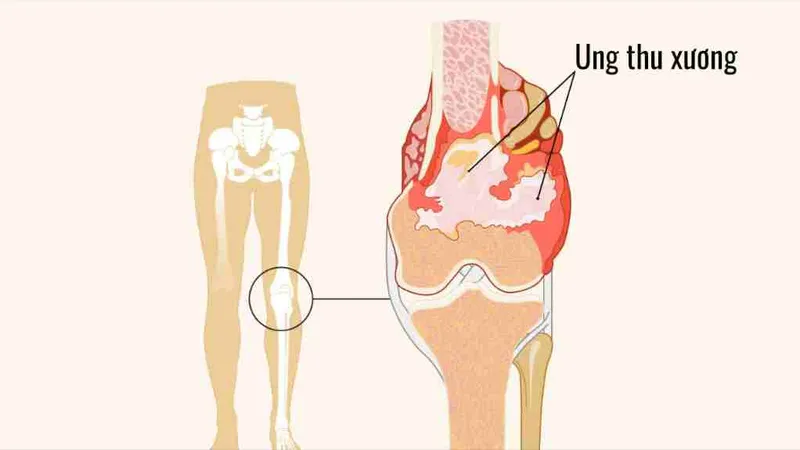 Bệnh nhân ung thư xương khó tiếp cận phương pháp điều trị tiên tiến