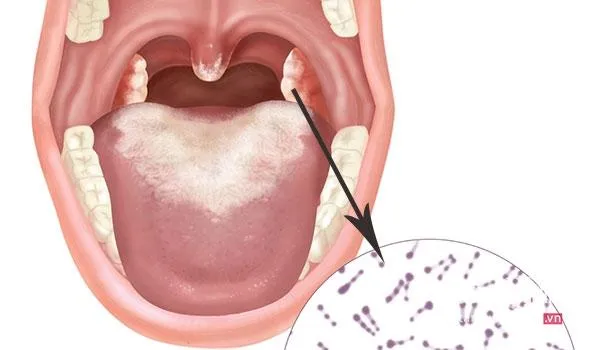 Tại sao bệnh bạch hầu nguy hiểm? 