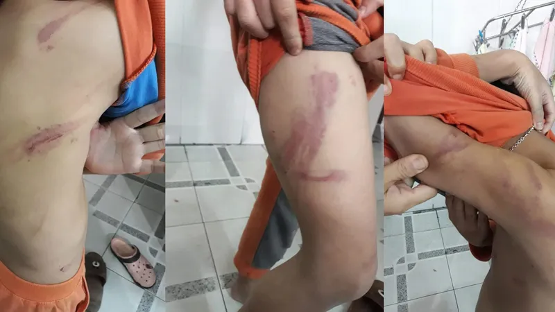 Cháu H.N.N. bị cha ruột đánh 