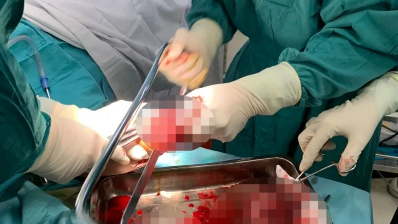 Thanh niên bị nát 2 bàn tay, dập phổi khi dùng kíp nổ để đánh cá