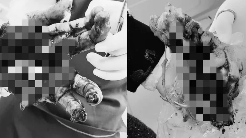Một trường hợp bị pháo nổ làm nát 2 bàn tay