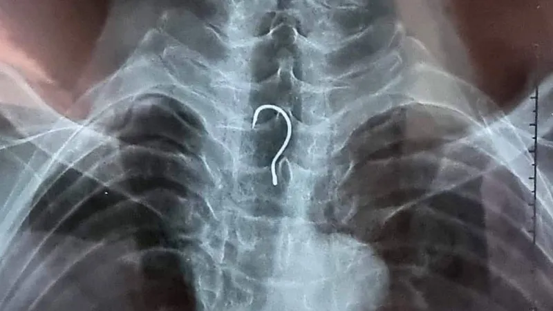 Các bác sĩ tiến hành nội soi gắp lưỡi câu trong thực quản bệnh nhân