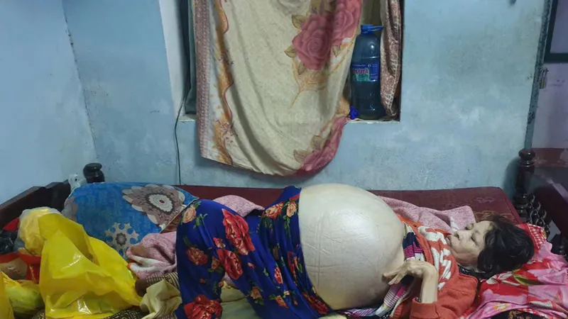 Hỗ trợ người phụ nữ xơ gan giai đoạn cuối