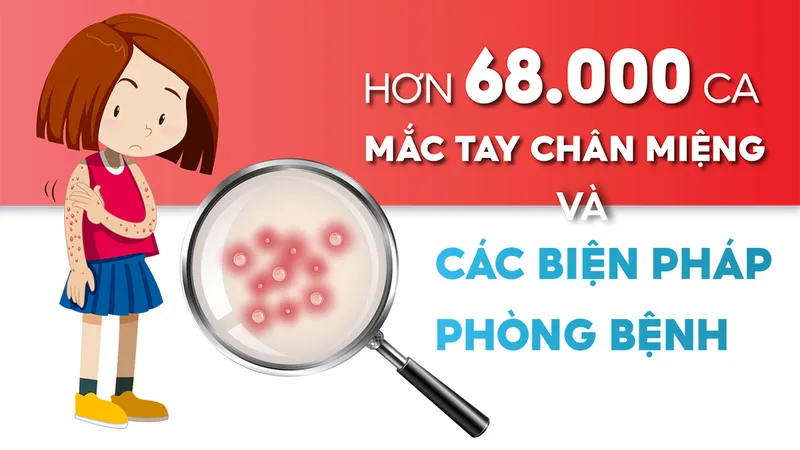 Hơn 68.000 ca mắc tay chân miệng và các pháp phòng bệnh