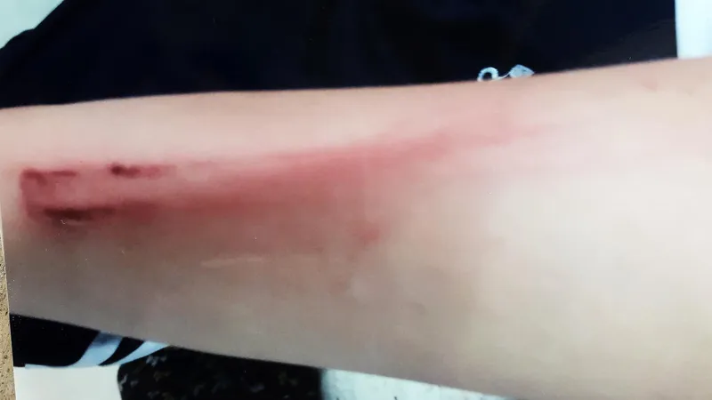 Mồ côi mẹ, bé gái 12 tuổi bị cha ruột đánh phải nhập viện