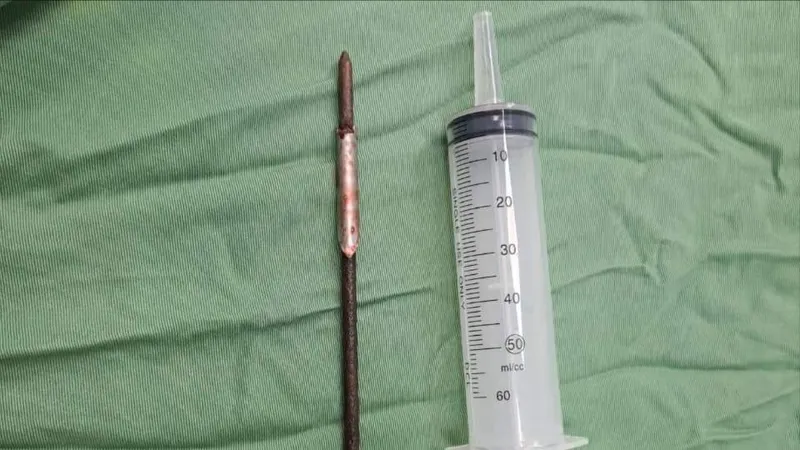 Cứu sống 1 người bị mũi tên đâm xuyên phổi