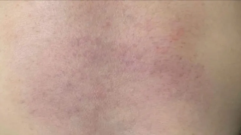 Vết bầm tím trên cơ thể cháu Q. được chia sẻ trên mạng xã hội
