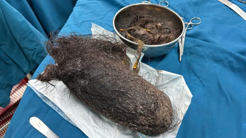 Quảng Ngãi: Phẫu thuật lấy búi tóc nặng 900gram trong dạ dày bé gái