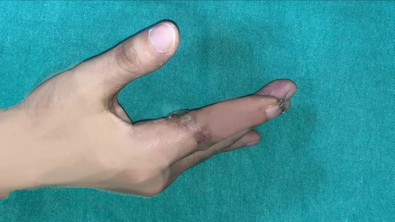 Lần đầu tiên, vi phẫu thành công cứu sống ngón tay của một thủy thủ bị đứt rời sau 25 giờ