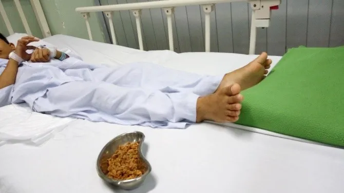 Bé trai 11 tuổi bị tắc hậu môn do nuốt hơn 70 gram hạt sơ ri