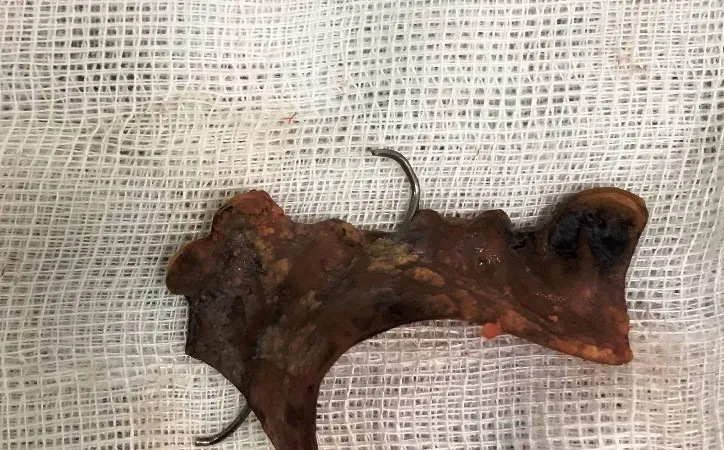 Vệ sinh cá nhân, nuốt hàm răng giả dài 4cm
