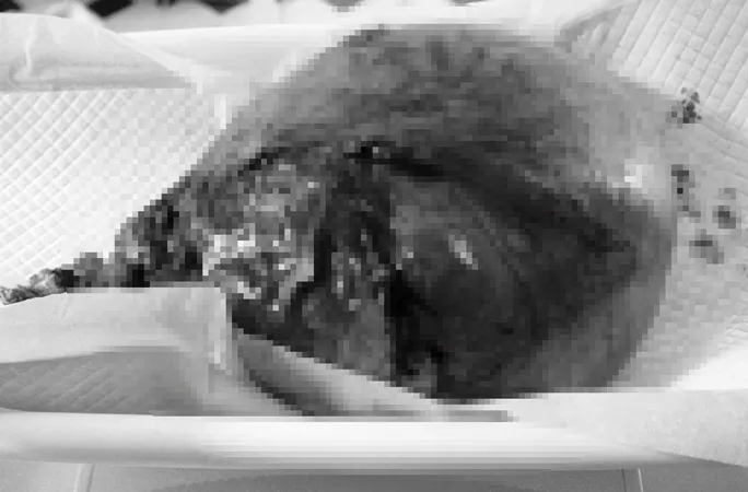 Phẫu thuật thành công cho bệnh nhân có khối u xơ tử cung nặng tới 4kg